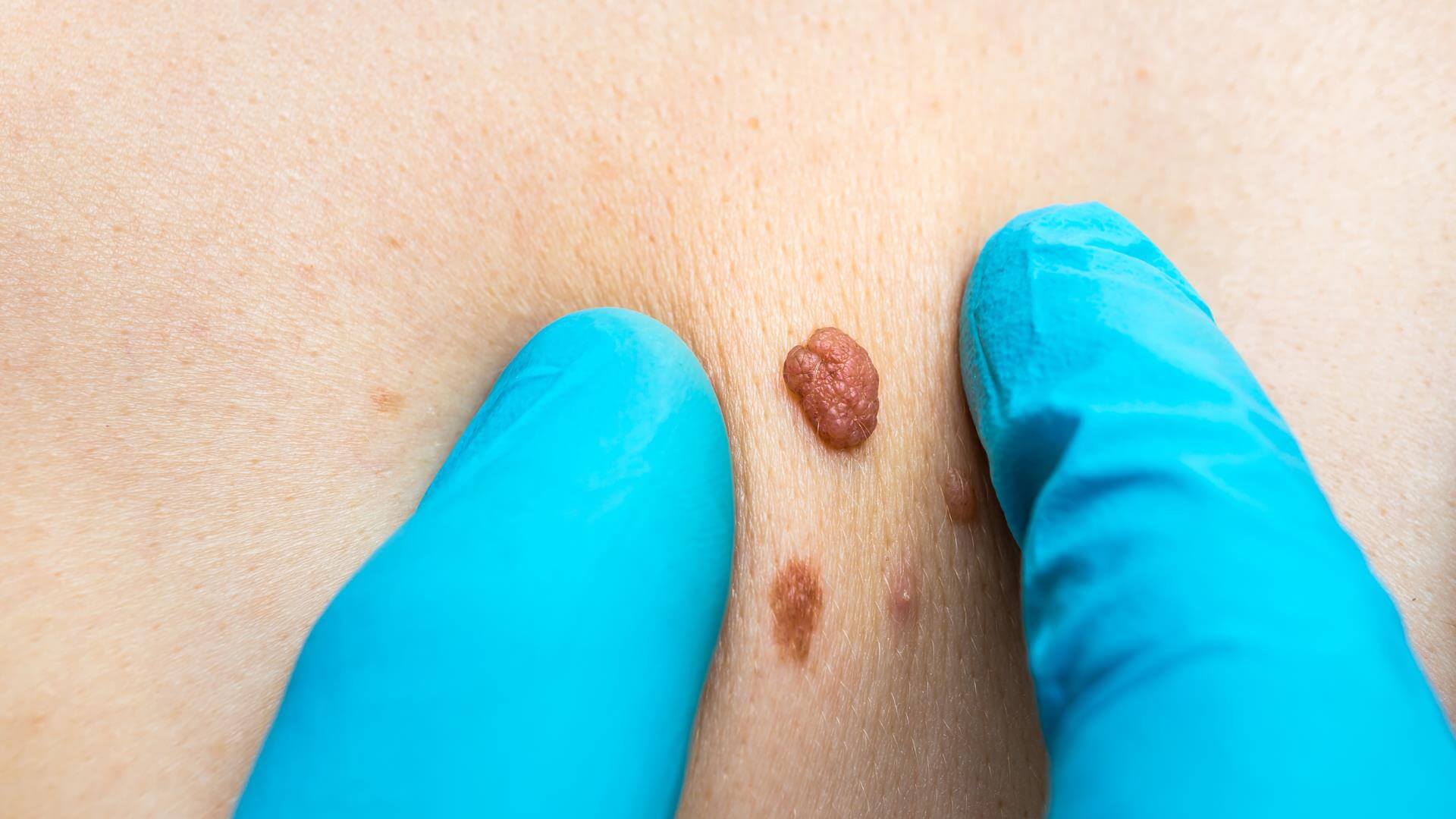 Close-up of a skin tag being assessed by a practitioner