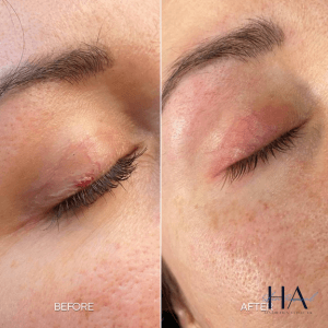 Before and after skin revival close-up around the eye