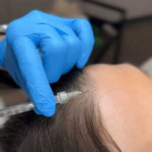 PRP hairline treatment in progress