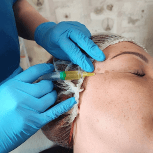 PRP facial treatment in progress at Helena Aesthetics