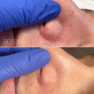 Before and after skin tag removal result from Helena Aesthetics